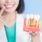 The Cost of Dental Implant in Korea